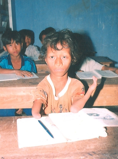 少数民族村の奇跡 枯葉剤被害の少年 特集 Vietjoベトナムニュース