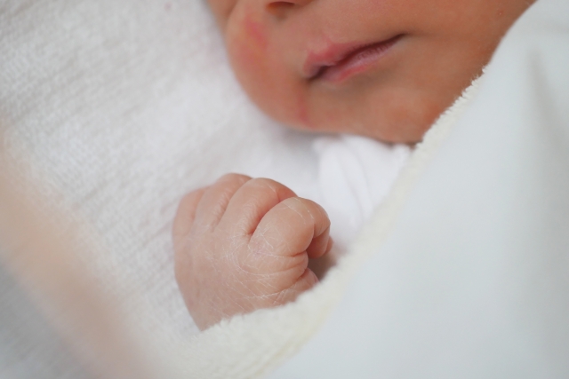 クアンニン省 少数民族の母親が道化師様魚鱗癬の男児を早産 三面 Vietjoベトナムニュース