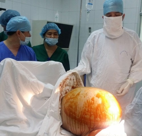 妊婦 のお腹にいたのは重さ7キロの巨大腫瘍 切除手術に成功 社会 Vietjoベトナムニュース