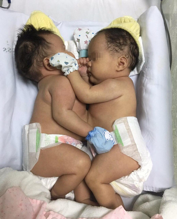 ホーチミン 結合双生児分離手術に成功 第1小児病院 社会 Vietjoベトナムニュース