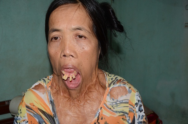 火傷で半世紀口を開いたままの女性 皮膚再建手術で人生に変化 社会 Vietjoベトナムニュース